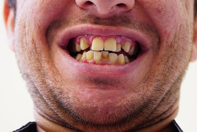 Sådan planlægger du forløbet med invisalign tandregulering fra start til slut